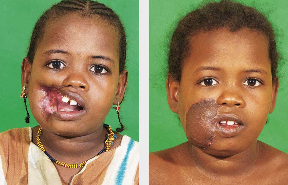 Mother with Child. Aisha before and after operation.